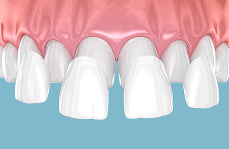 短期間で歯を白くするラミネートべニアにも対応
