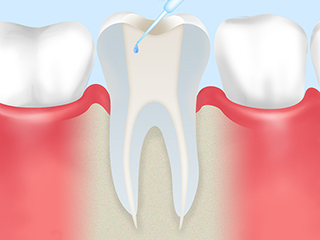 根管内の消毒