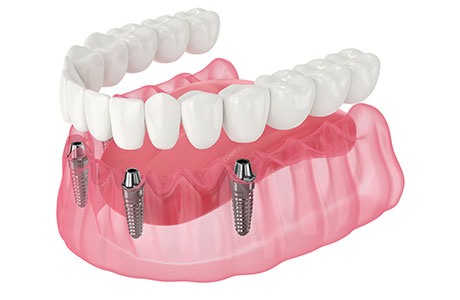 わずか4本のインプラントで歯を支える安心・安全な「オールオン4」