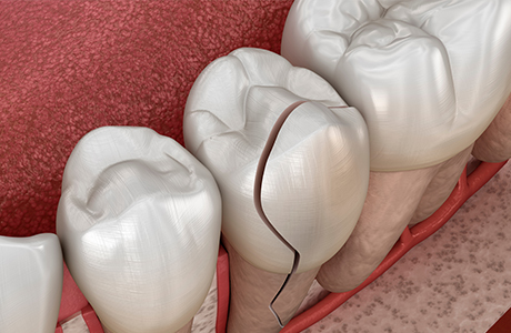 歯が欠ける・割れる、詰め物・被せ物が壊れる