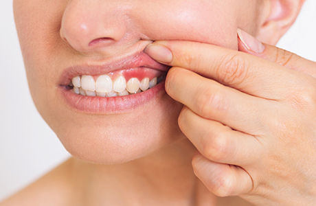 歯周病が悪化して歯周組織に炎症が生じる