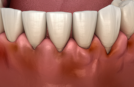 歯茎の黒ずみは歯周病のせい？
