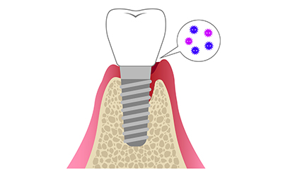 インプラント周囲炎に注意しましょう