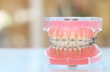 ワイヤー矯正の場合